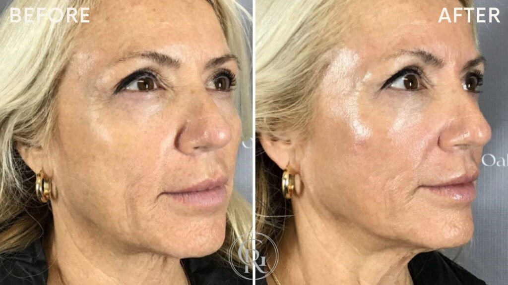 Wrinkles and skin texture improved after treatment, showing a smoother and more youthful appearance.