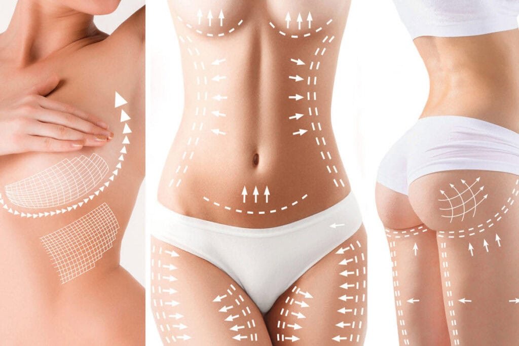 Body contouring treatment illustration with markings on abdomen, waist, and hips.
