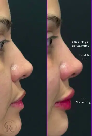 Before and after dermal filler treatment showing nose and lip enhancements.