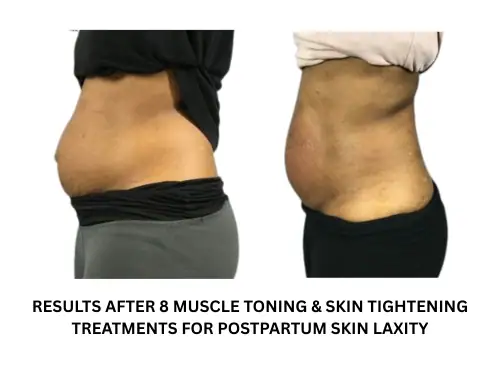 Before and after results of muscle toning and skin tightening treatments.
