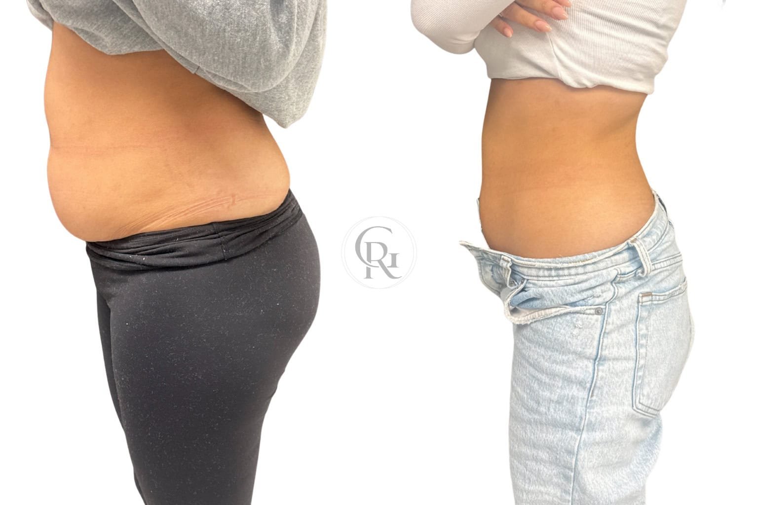 ROG Medspa Weight loss before and after side view