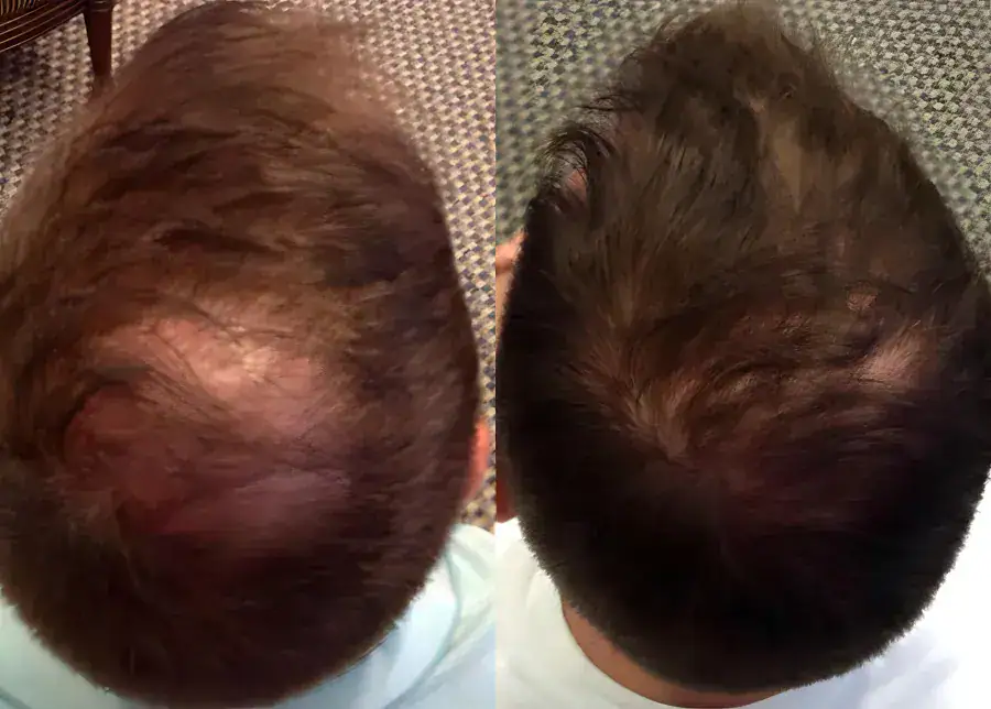Thinning hair before hair transplant procedure in Houston, TX.