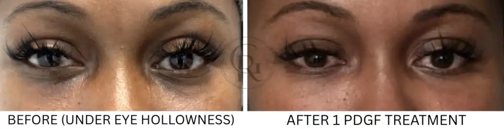 Dark under eye area before and after treatment showing improved skin smoothness.