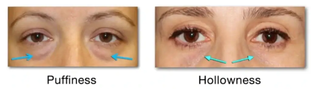 Under Eye Rejuvenation Houston, TX.